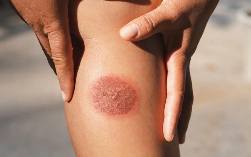 Kaki Kena Knalpot Memang Tidak Mengenakan, Berikut Tips Mengobatinya