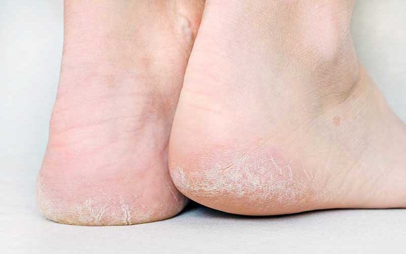 Tumit Pecah-Pecah Memang Bikin Ga Pede, Berikut Ini Tips Untuk Menghilangkannya