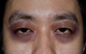 Cara Mengatasi Mata Panda Dengan Bahan Alami, Simak!