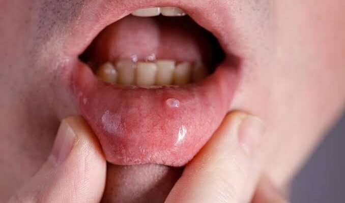 Benjolan di Mulut Mirip Sariawan? Bisa Jadi Mukokel, Ini Ciri-cirinya Ilustrasi mukokel berupa benjolan di bagian dalam bibir - Foto: Hello sehat